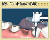 続いて小臼歯の形成